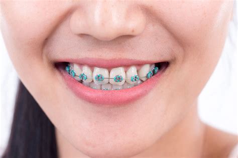 日常贴士到底要不要去绑牙有这三个特点的牙齿可考虑矫正为提升颜值作出最合适的选择