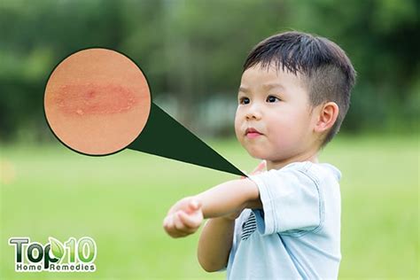 Home Remedies To Treat Ringworm In Kids 9 Safe Ways Top 10 Home Remedies
