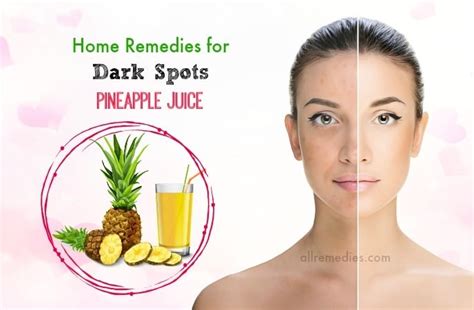 21 Must Know Home Remedies For Dark Spots Removal On Face And Neck