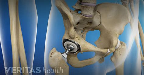 Hip Replacement Surgery Video Arthritis Health