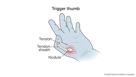 Trigger Thumb Boston Childrens Hospital