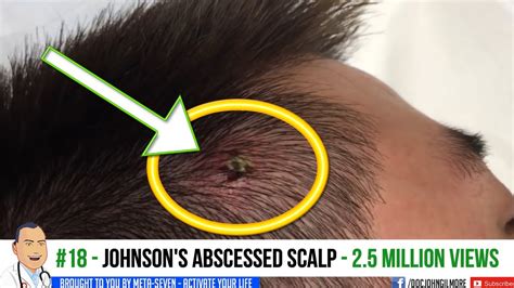 Abscessed Scalp Johnsons Infected Scalp Abscess Youtube