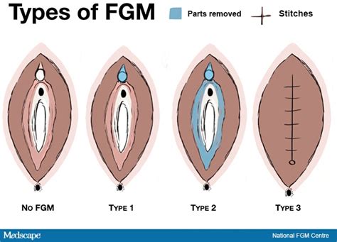 Under The Radar Female Genital Mutilation In The United States