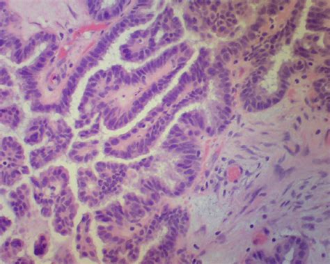 He Stained Sections Of Right Ovary Showing Borderline Serous Tumor