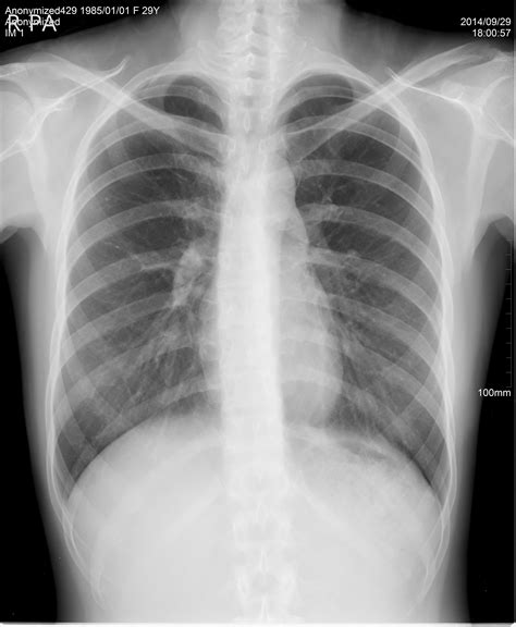 Chest Pa Digital X Ray Image Made By A Cr Unit