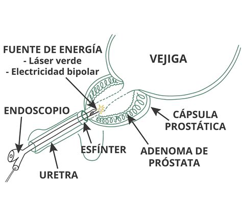 Cirugía Endoscópica De Vejiga E Hiperplasia De Próstata Urología Hospitalaria