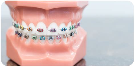 Cost Of Braces How Much Braces Really Cost Fusion Orthodontics