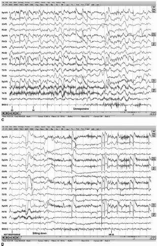 Eeg And Epilepsy Neupsy Key