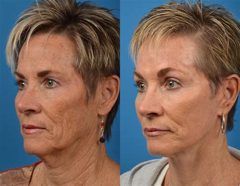 Facelift Photos Melbourne Fl Patient 57833