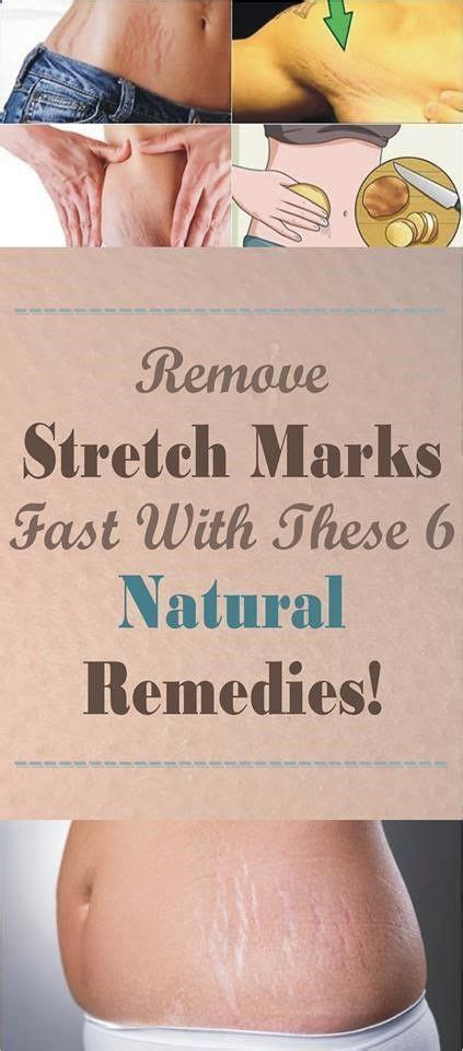 You Wont Believe You Can Remove Stretch Marks Fast With These 6