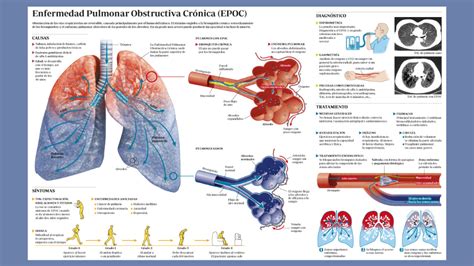 Infograf A Explicativa De La Enfermedad Pulmonar Obstructiva Cr Nica Epoc Med School Harem