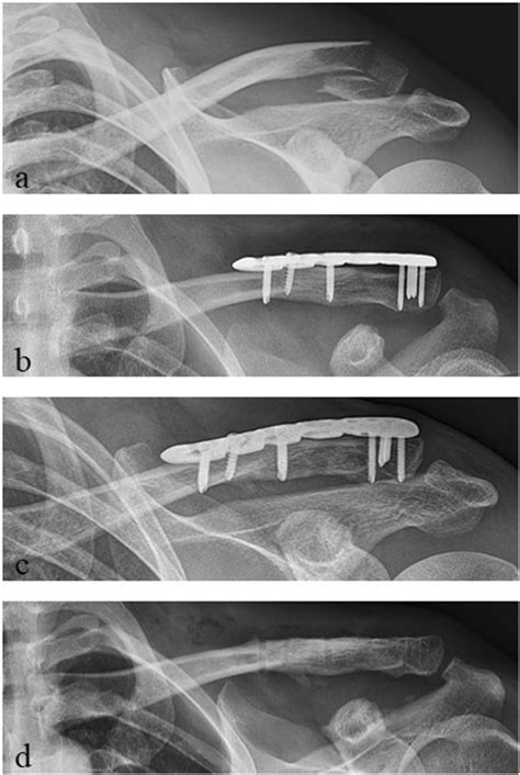 Radiological Outcome Of A Lateral Clavicle Fracture Jandb Ii A Neer Ii