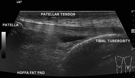 Deep Infrapatellar Bursitis Radiology Reference Article Radiopaedia Org