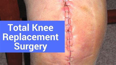 What Happens After Total Knee Replacement Surgery Youtube