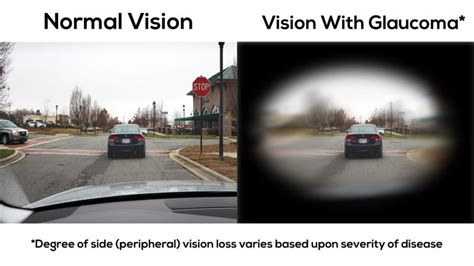 Legally Blind — Vision Rehab Ot