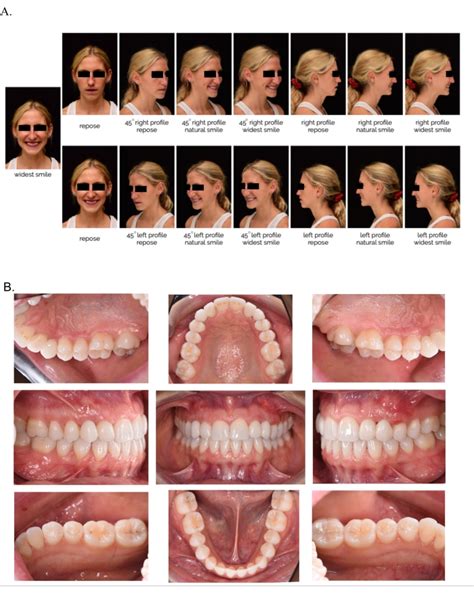 A Standardized Approach To Extra Oral And Intra Oral Digital Photography