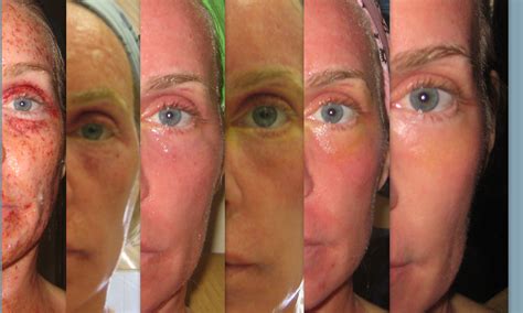 Co Fractional Laser Process Beauty Aids Tips Pinterest Laser Treatment Skin Treatments