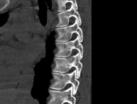 Osteoid Osteoma Of The Spine Radiology Case