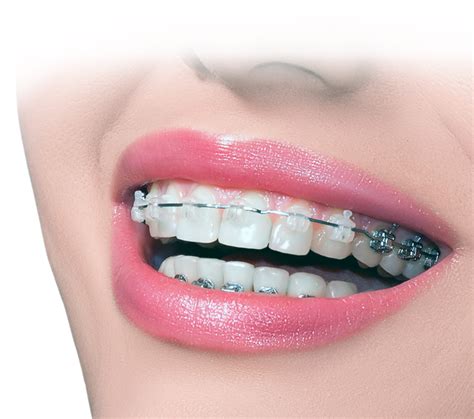 Braces Png Images Transparent Background Png Play