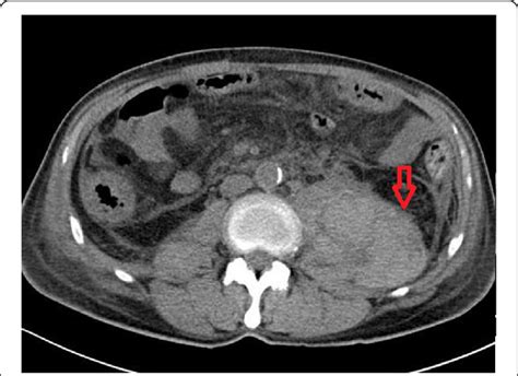 Radiographic Imaging Revealed A Massive Hematoma Of The Left Psoas