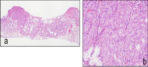 A In Low Power View The Well Demarcated Lesion Is Composed Of