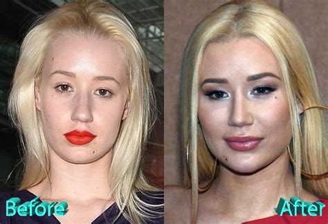 iggy azalea before and after cosmetic surgery celebrity plastic surgery plastic surgery