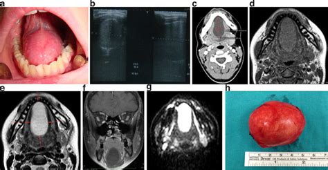 Imaging Of 18 Year Old Female Patient With Sublingual Dermoid Cyst