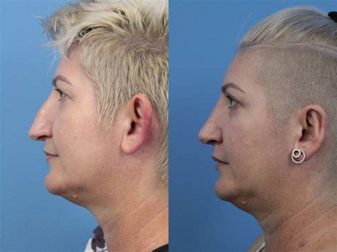 Rhinoplasty Before And After Pictures Case 250 West Des Moines Ia