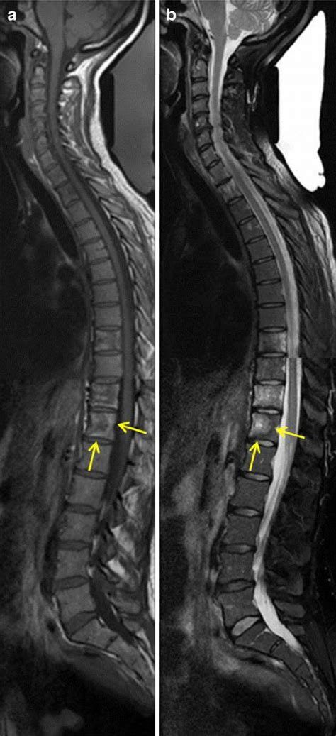 Baseline Examination A Sagittal Mri Of The Spine Shows Multiple