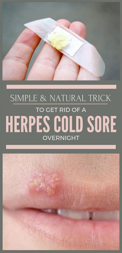 How To Get Rid Of A Cold Sore Overnight