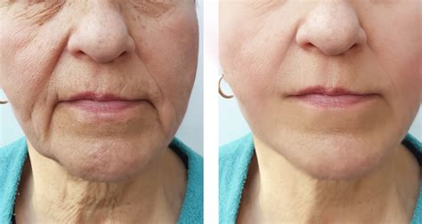 Face Of An Elderly Woman Wrinkles Face Before And After Procedures