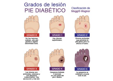 Pie Diabético Unidad de Patología Vascular