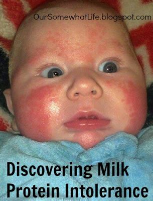 Treatment of allergies to milk. Our Somewhat Life: Discovering Milk Protein Intolerance