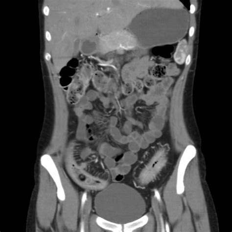 Crohn Disease Image
