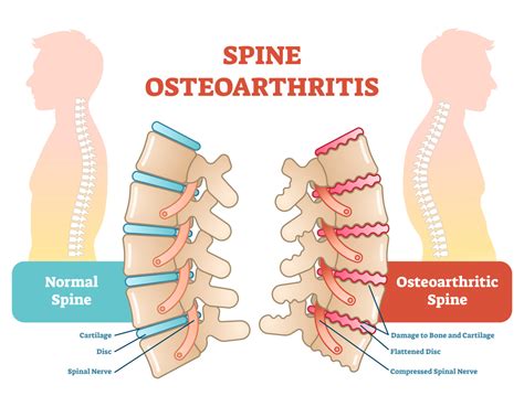 What Is Osteoarthritis And How Does It Affect My Spine