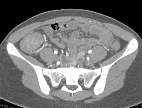 Crohns With Active Disease In Terminal Ileum And Cecum Small Bowel