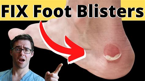How To Treat A Foot Blister Toe Blister Or Heel Blister Pop It