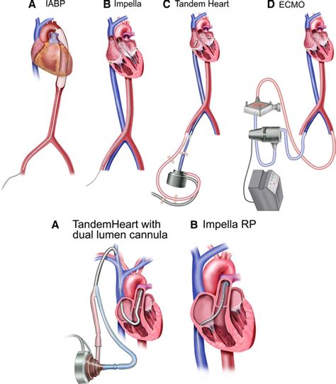 Percutaneous Mechanical Circulatory Support Devices In Cardiogenic