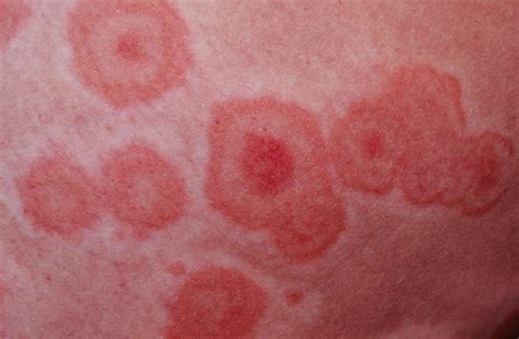Erythema Multiforme Causes Types Symptoms Diagnosis And Treatment