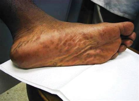 What Causes Black Spots On The Bottom Of Your Feet Quora