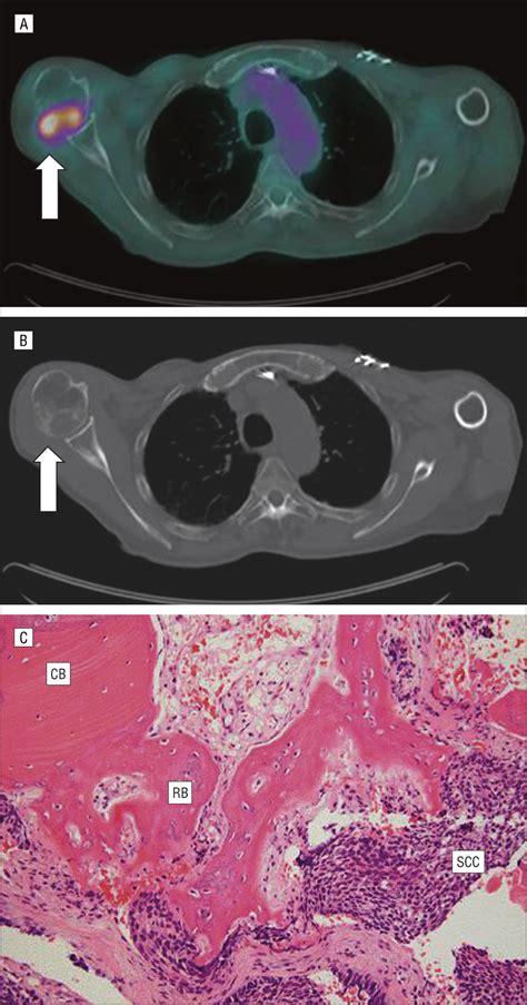 Detection Of Occult Bone Metastases From Head And Neck Squamous Cell