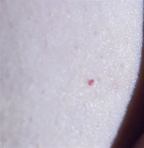 Bright Red Freckle Like Dots On Breast I Am 22 I Have Another One Too