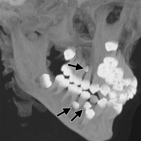 Radiopaque Jaw Lesions An Approach To The Differential Diagnosis