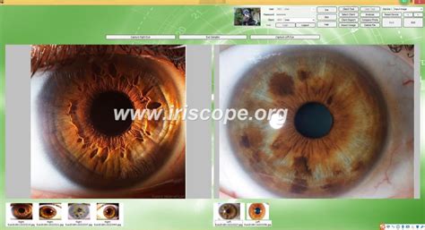 Iridology Camera Reviews Is It Worth It Iriscope Iridology Camera