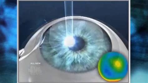 In order to determine how long lasik benefits last, researchers measure visual acuity right after surgery, and they take now that lasik is considered a standard surgical procedure, there are fewer studies performed. How long does LASIK laser eye surgery last?
