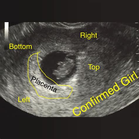 Confirmed Boy And Girl Ultrasound Scans A Collection Of Boy And Girl