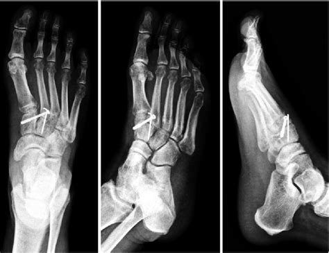 On physical examination, swelling is found primarily over the midfoot regi … Open reduction with internal fixation for Lisfranc joint ...