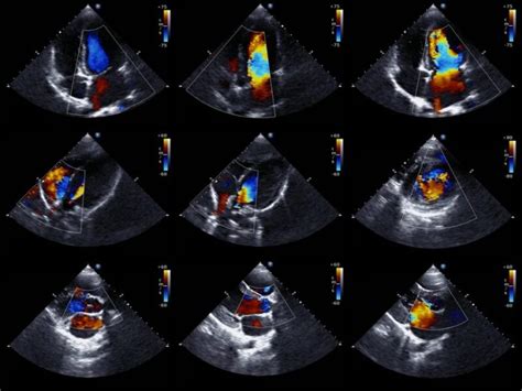 Echocardiogram Definition Uses Procedure And Side Effects Irving Radiology