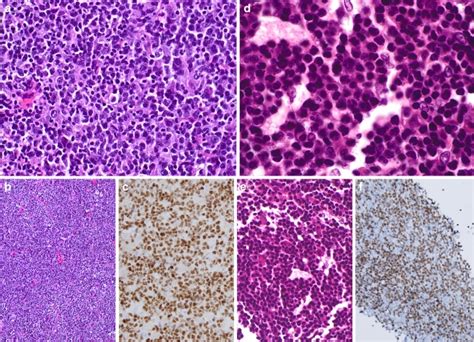 Histologic And Immunohistochemical Findings Of The Patients B Cell