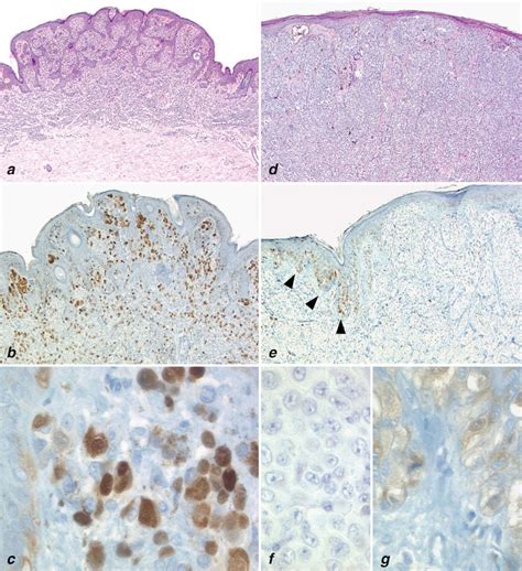 P16 Expression In Primary Malignant Melanoma Is Associated With